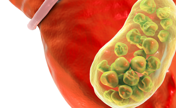 Batu Kantung Empedu Gejala, Diagnosis, dan Pengobatan