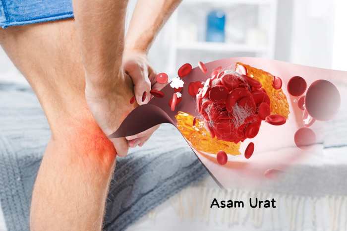 Penderita asam urat