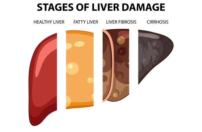 Ciri-ciri Penyakit Liver