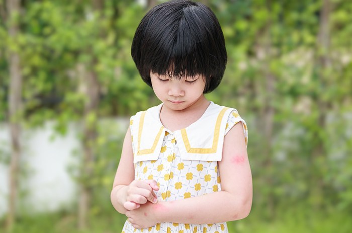 Si Kecil Punya Alergi Makanan? Simak Mitos dan Faktanya di Sini, Bun Ciri-ciri Alergi Makanan pada Anak