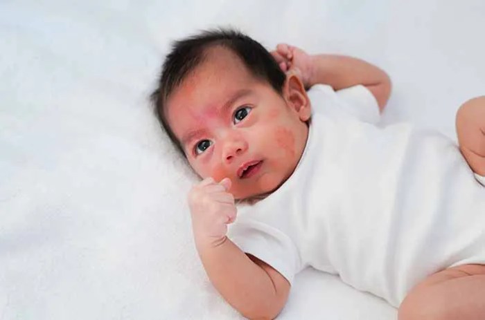 Ibu, Kenali 6 Ciri-Ciri Alergi Makanan pada Bayi Ibu, Kenali 6 Ciri-Ciri Alergi Makanan pada Bayi